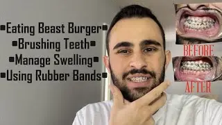 Double Jaw Surgery | Post-Op 2 Month Update