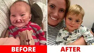 Parents Refuse To Abort Their &lsquo;deformed&rsquo; Baby, You Won&rsquo;t Believe How He Looked Like 2 Years Later