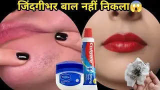 डॉक्टर ने बताया👉बिना किसी दर्द चेहरे के बाल हटाने का ये दो बूंद लगते ही हैरान हूं😱|| facial hair