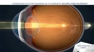 HİPERMETROP NASIL OLUŞUR ve TEDAVİSİ NEDİR?