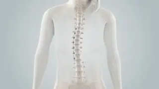 Spinal Tethering Surgery