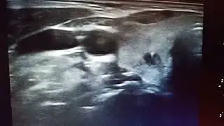 &Eacute;chographie thyro&iuml;dienne Kystes collo&iuml;des