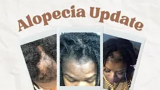 My hair is BACK!! Locs with Alopecia Update