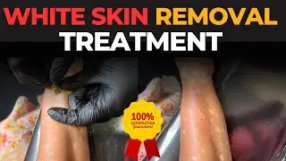 Vitiligo 100% success rate | Permanent solution | Machu Tattoos