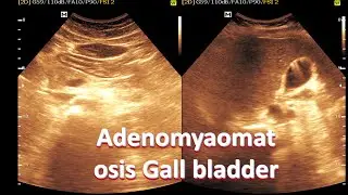 Ultrasound cases 211 of 2000 || Adenomyomatosis Gall Bladder