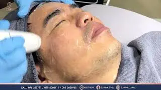 Liftera A เลเซอร์ยกกระชับสำหรับใบหน้า - Sutthisak Clinic