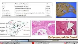 Caroli's disease and syndrome