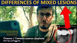 EASY Cemento Osseous Dysplasia X rays: All diferences of Mixed Periapical Lesions - Radiology Tips