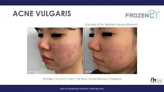 Clinical Photos &  Video Agassi, Platon and  Frozen C