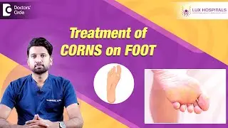 Foot corn removal | Deep corn on bottom of foot | Corn Cap| Corn Surgery #footcare-Dr.Abhishek Katha
