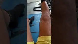 Day 34 AcL and meniscus surgery Rehab #aclsurgery #RecoveryJourney #aclrecovery #meniscus #LCA
