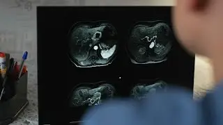 More people are living 5 years after cancer diagnosis, new data shows