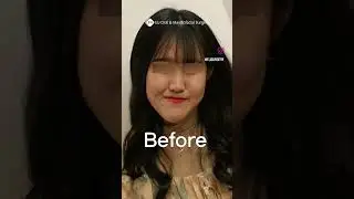 Korean Double Jaw Surgery + V-Line Surgery Results | (Before & After)