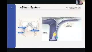 Обновленная информация о клиническом применении eShunt - исследование MSH STRIDE