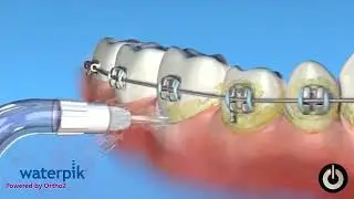 Say Goodbye to Braces Woes: Learn How to Use Water Floss Properly