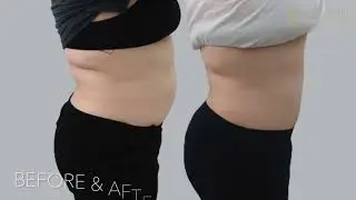 Fat Freezing - Social Media Promotion Video