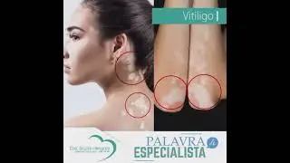 Vitiligo