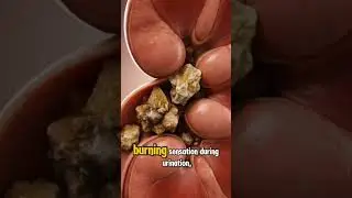 How Kidney Stones Form Inside the Human Body | 3D Medical Animation #kidneyhealth