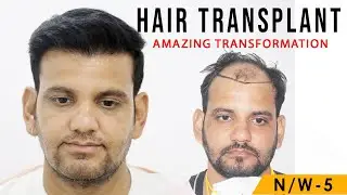 The Best Hair Transplant in India in best Cost | Medispa India | Dr Suneet Soni