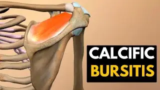 Calcific Bursitis, Causes, Signs and Symptoms, Diagnosis and Treatment.