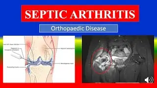 SEPTIC ARTHRITIS - Definition, types, causes, pathophysiology, symptoms , diagnoses , medicine
