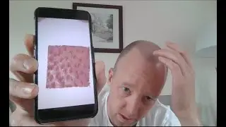 Day 7: Video Diary. 2000 FUE with Dr Ball Maitland Clinic UK