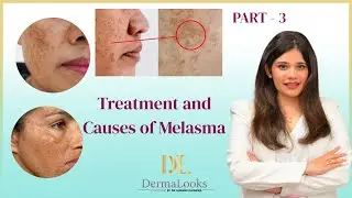Melasma Causes, Prevention & Treatments Part 3 | Dr. Surabhi Sharma | Dermalooks Skin & Hair Clinic