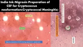 Capsules of Cryptococcus neoformans in India Ink or Nigrosin Preparation of CSF