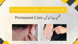 Can 20-year-old Psoriasis be permanently cured with Homeopathic Medicine? | Skin Health