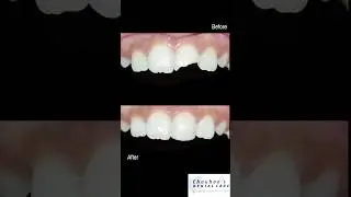 From Fracture to Flawless! One visit.One filling. #pediatricdentist#cosmeticfilling