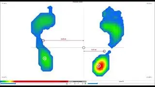 Trattamento Osteopatico Parkinson, progetto di tesi