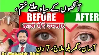 Under eye Dark Circles treatment at home | Ankhon ke niche dark Circles Kese Hataye