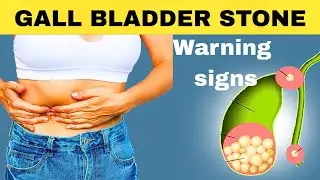 Gall bladder stone symptoms | gallstone treatment #gallstonetreatment @Gyanear 