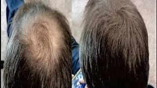 How to Hide Balding and Thinning Hair - CHEAPLY!!!