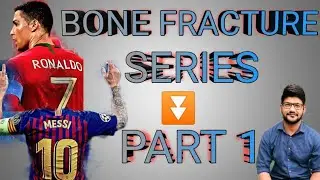 Dr Tricks - Named Bone Fracture Series | PART 1 - Metacarpal Bone Fracture l