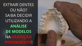 Extrair Dentes ou N&atilde;o? Saiba decidir utilizando a An&aacute;lise de Modelos na Denti&ccedil;&atilde;o Permanente!