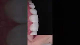 Clareamento + Resina Composta Direta! #dentes #dentistas #odontologia #odonto