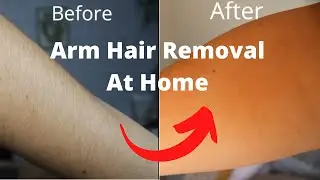 KetchBeauty at Home Laser Hair Removal Results Before and After