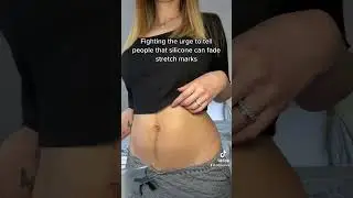 Stretch mark solution 🤩