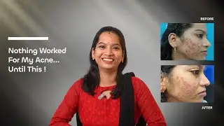 Tejaswini Finally Found a Solution for Stubborn Pimples