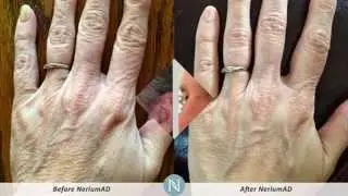 NeriumAD Before and Afters