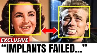 The WORST Dental Implants in Old Hollywood