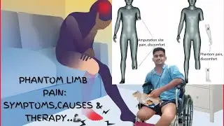 Phantom Limb Pain||Symptoms,Causes & Therapy||Amputee Vlog #6 #ottobock #disability #prostheticleg