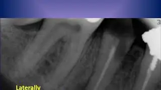 Management of laterally positioned periapical lesion