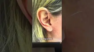Earlobe, aesthetics matter, too! #plasticsurgeon #earlobe #laser ￼