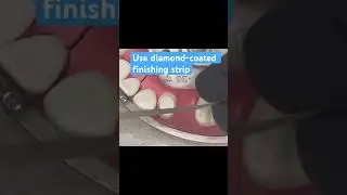 Nicked the Adjacent Tooth During Your ADEX Exam Prep? Do This.