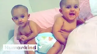 Conjoined twins have life-saving separation surgery | Humankind