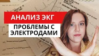 Анализ ЭКГ. Как понять по ЭКГ, что неправильно наложены электроды??