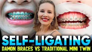 Self-Ligating / Damon Braces vs  Traditional Mini Twin