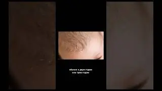 Молочные детские корочки трихолог #stophairloss #hairloss #scalpcare #scalphealth #trichology